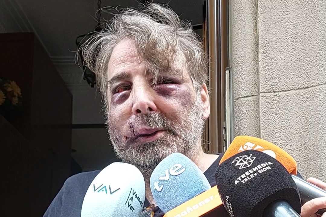 Valentín, el vecino de la calle Magdalena, con varios hematomas y puntos de sutura | ENFOQUES